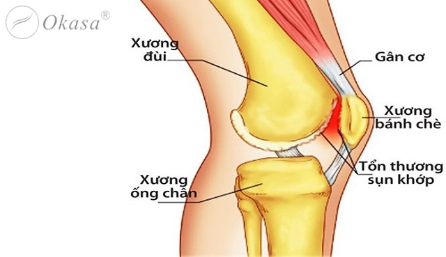 Dấu hiệu đầu gối bị chấn thương khi chơi thể thao