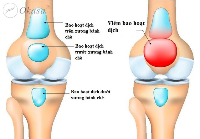 Dấu hiệu đầu gối bị chấn thương khi chơi thể thao