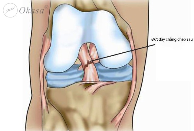 Dấu hiệu đầu gối bị chấn thương khi chơi thể thao
