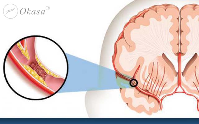Dấu hiệu nhận biết sớm đột quỵ