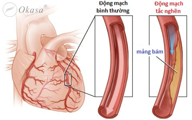 Dấu hiệu nhận biết và chẩn đoán xơ vữa động mạch