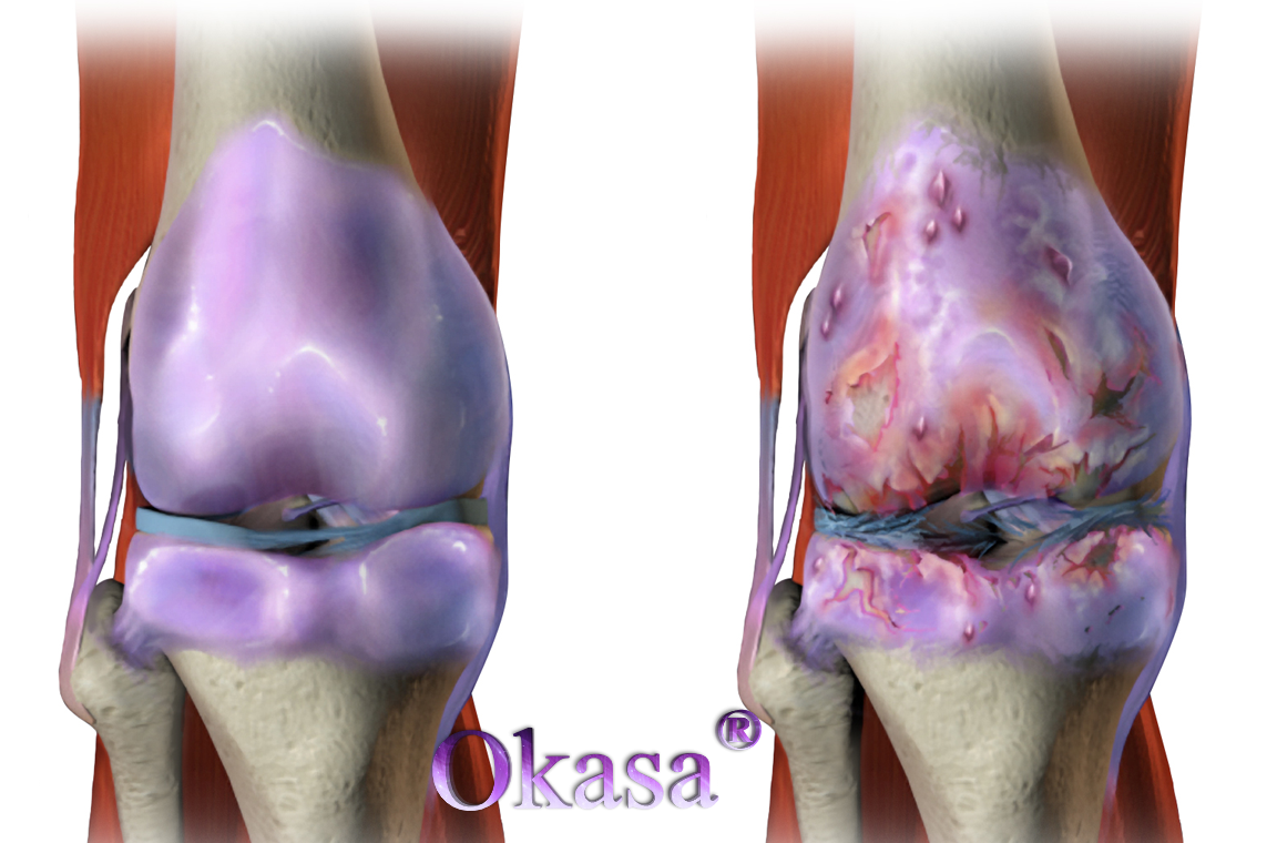 đau nhức xương khớp