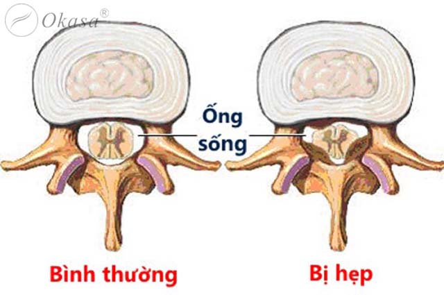 Hiểu về dây chằng vàng gây hẹp ống sống