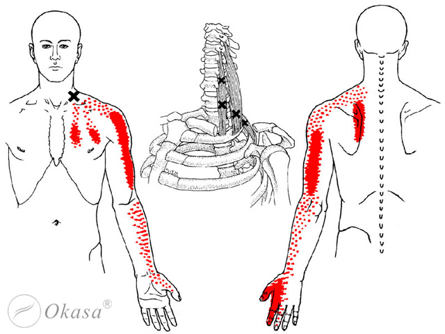 Điểm nút cơ ảnh hưởng đến các mô và hệ cơ quan