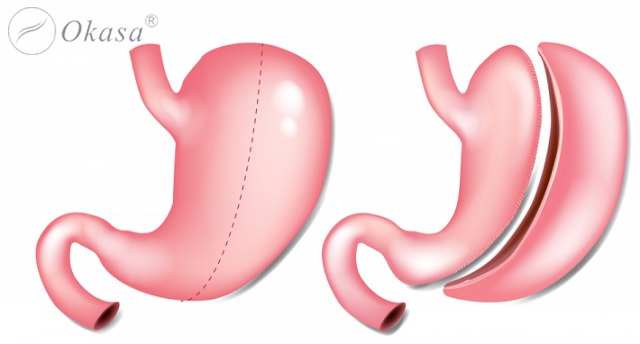 Điều trị bệnh béo phì ở người trưởng thành