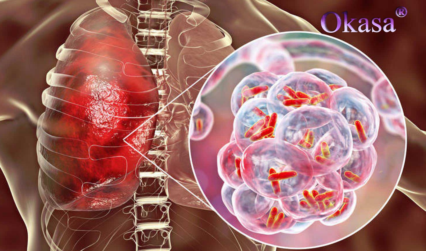 điều trị bệnh lao xương