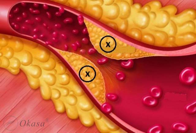 Điều trị bệnh rối loạn lipid máu cần lưu ý gì?