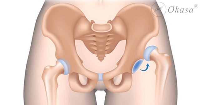 Điều trị chấn thương cổ xương đùi ở người cao tuổi