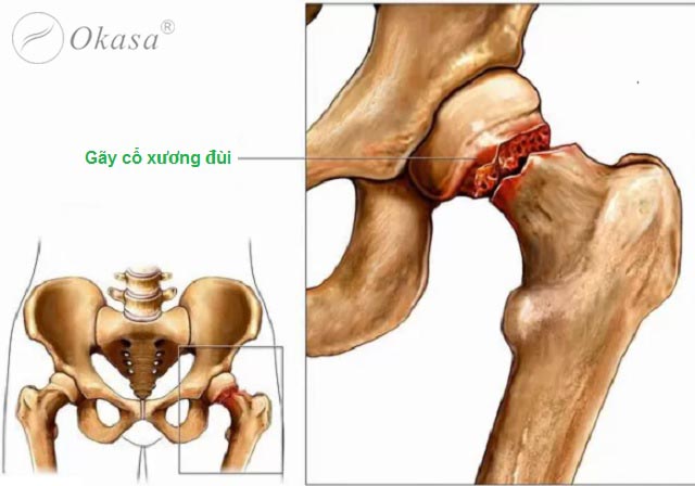 Điều trị chấn thương cổ xương đùi ở người cao tuổi