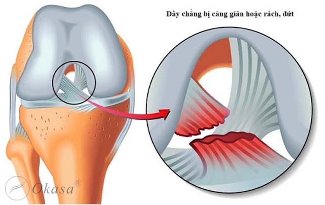 Điều trị chấn thương đứt dây chằng khớp gối