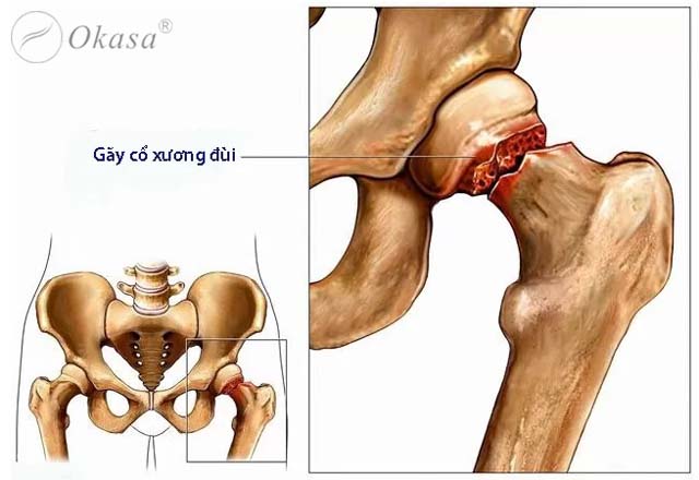 Điều trị gãy cổ xương đùi ở người cao tuổi