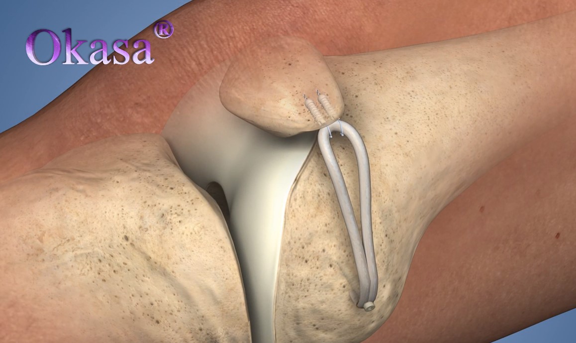 điều trị lỏng khớp gối