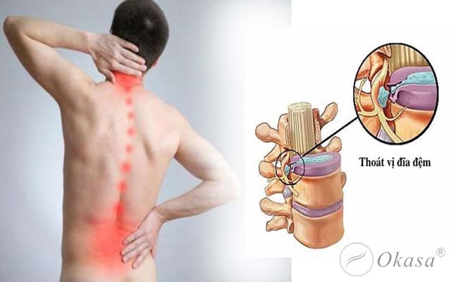 Điều trị thoát vị đĩa đệm cổ