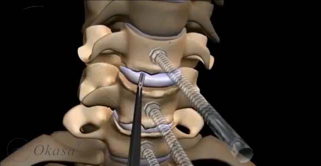 Điều trị thoát vị đĩa đệm cột sống cổ ngực
