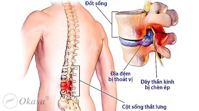 Điều trị thoát vị đĩa đệm cột sống thắt lưng