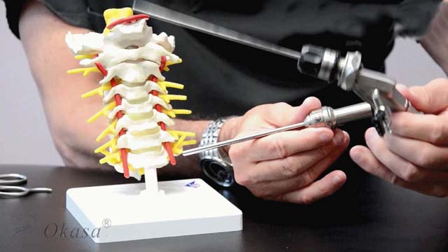 Điều trị thoát vị đĩa đệm cột sống thắt lưng
