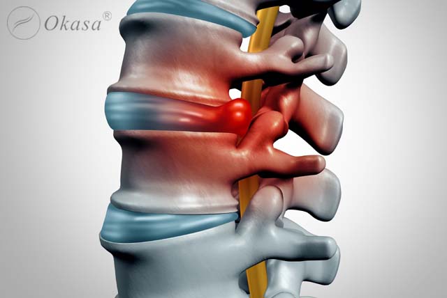 Điều trị thoát vị đĩa đệm lưng
