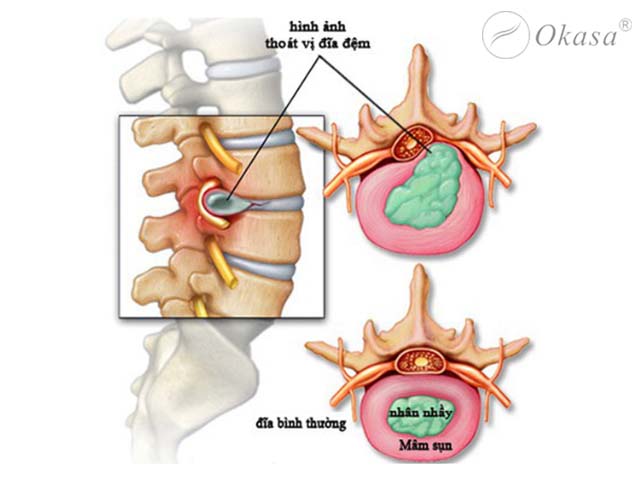 Điều trị thoát vị đĩa đệm lưng