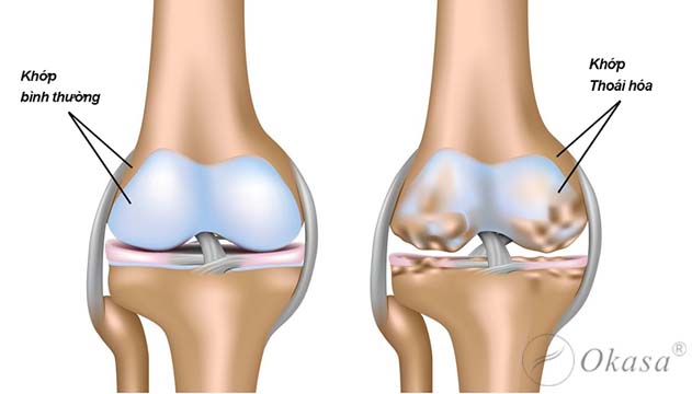 Điều trị và phòng tránh bệnh cứng khớp gối