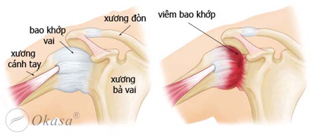 Điều trị viêm quanh khớp vai thể đông cứng