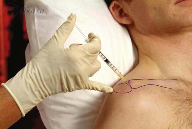 Điều trị viêm quanh khớp vai thể đông cứng