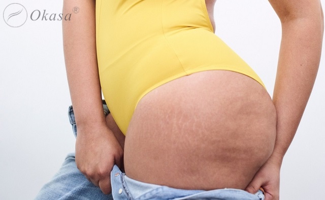 Dinh dưỡng cho người trưởng thành mắc bệnh béo phì