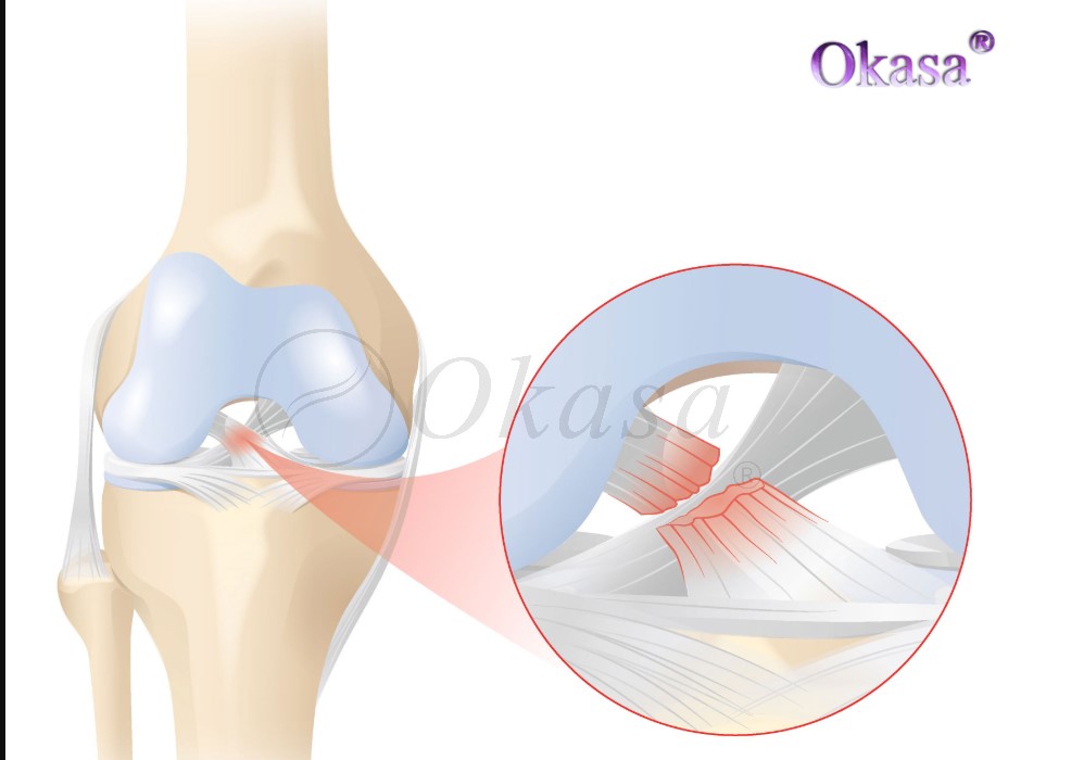 đứt dây chằng chéo