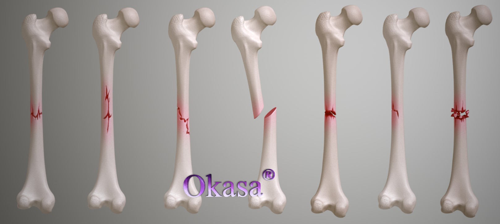 xương bị gãy nứt