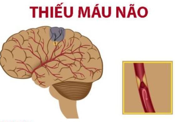 Hay bị đau đầu là triệu chứng của bệnh thiếu máu nặng