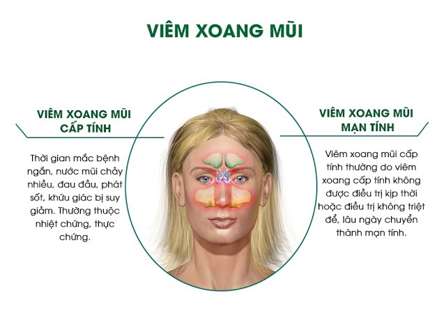 Hay bị đau đầu là triệu chứng của bệnh viêm xoang