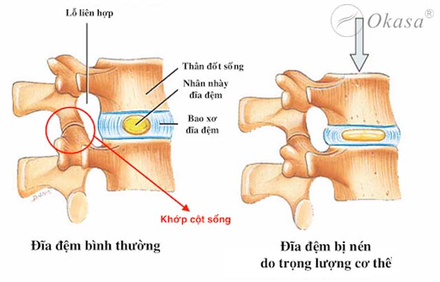 Hẹp lỗ liên hợp cột sống cổ do thoái hóa cột sống cổ