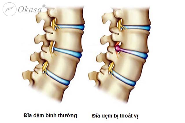 Hiện tượng cứng cổ không quay được đầu?