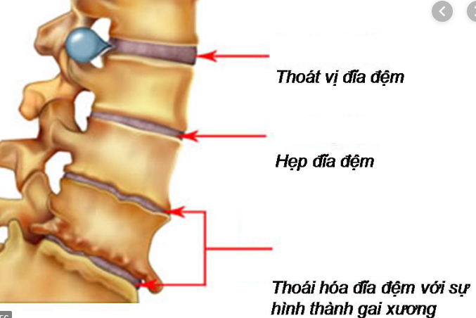 Hiện tượng đau cơ mông do bệnh thoát vị đĩa đệm