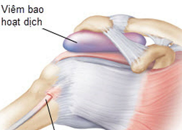 Hiện tượng đau cơ mông do bệnh viêm bao hoạt dịch