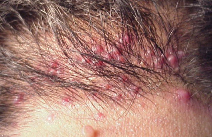 Hiện tượng đau cơ mông do U nang lông