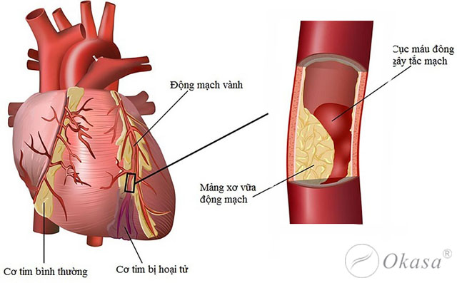 Hiểu về bệnh thiếu máu cơ tim