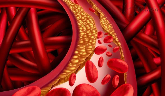 Hiểu về bệnh tim mạch chuyển hóa