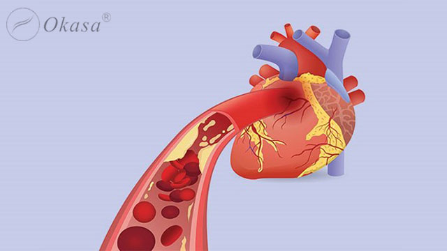 Hiểu về bệnh tim thiếu máu cục bộ mãn tính