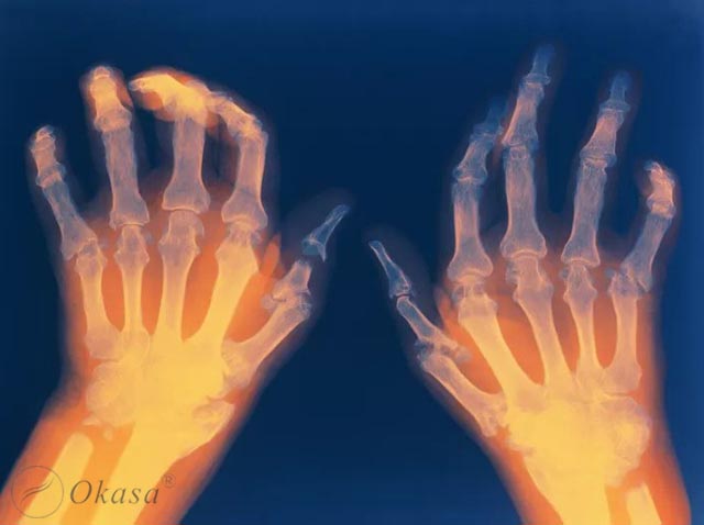 Hiểu về bệnh viêm khớp thiếu niên tự phát thể hệ thống