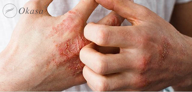 Hiểu về bệnh viêm khớp vảy nến