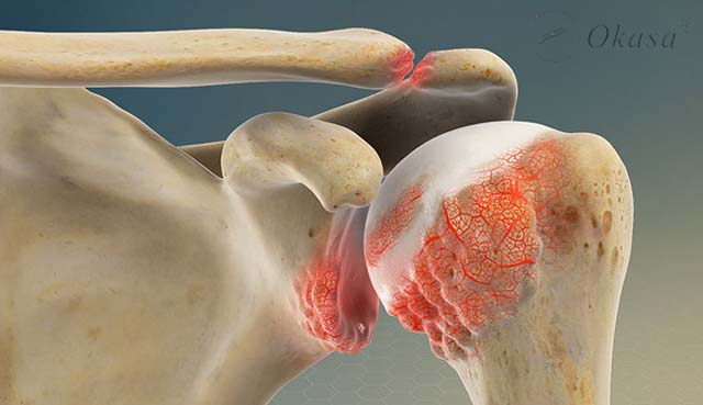 Hiểu về bệnh viêm quanh khớp vai