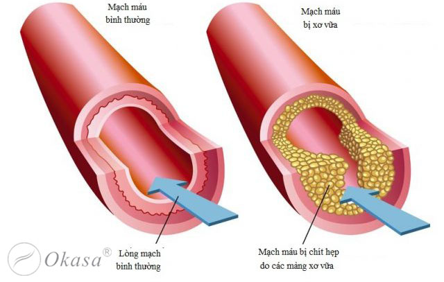 Hiểu về bệnh xơ vữa động mạch và vai trò của protein phản ứng C