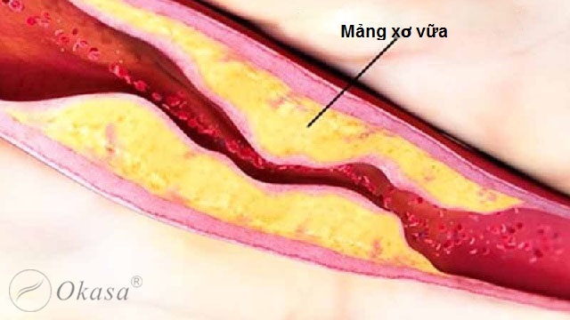 Hiểu về bệnh xơ vữa động mạch và vai trò của protein phản ứng C