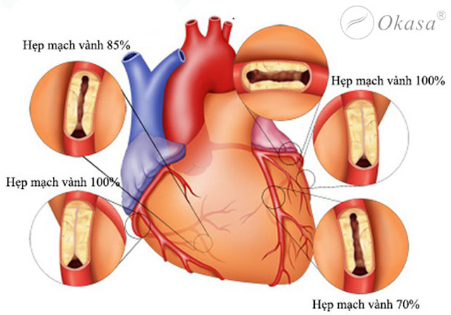 Hiểu về cơn đau thắt ngực điển hình và không điển hình