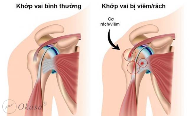 Hiểu về hội chứng bắt chẹn khớp vai mạn tính