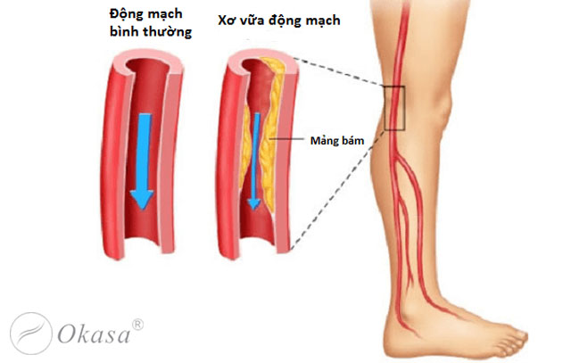 Hiểu về hội chứng thiếu máu chi