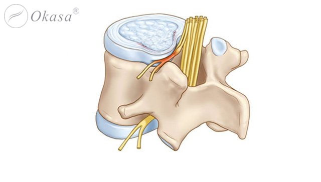 Hiểu về lồi đĩa đệm