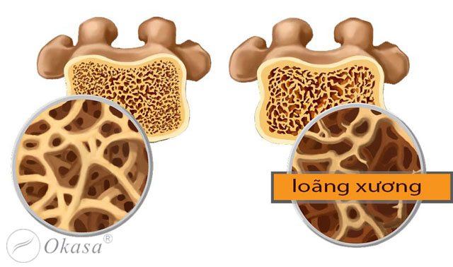 Hiểu về mật độ xương và bệnh loãng xương