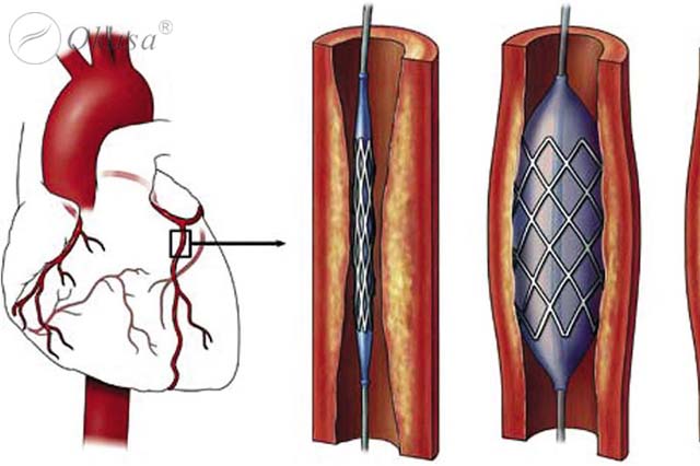 Hiểu về nong động mạch vành