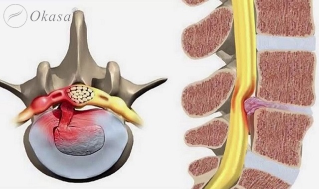 Hiểu về rách đĩa đệm